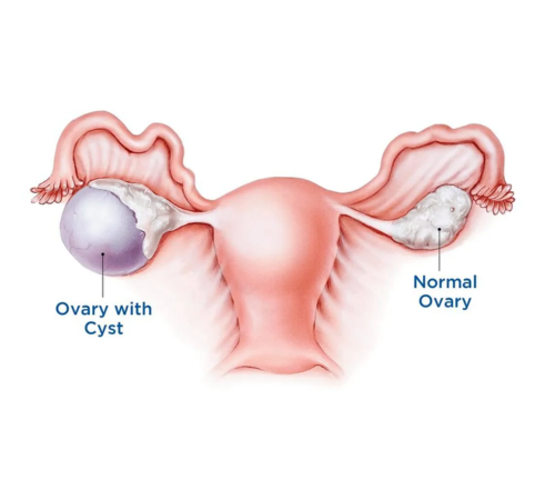 Ovarian Cystectomy